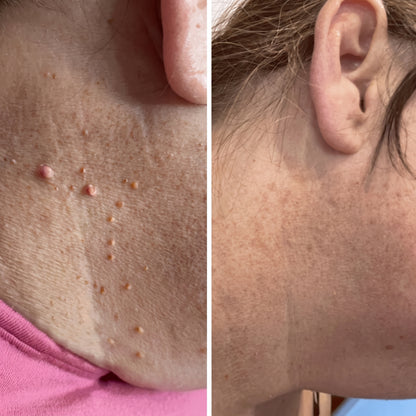 SUVORA™- Painless Skin Tag Removal Kit