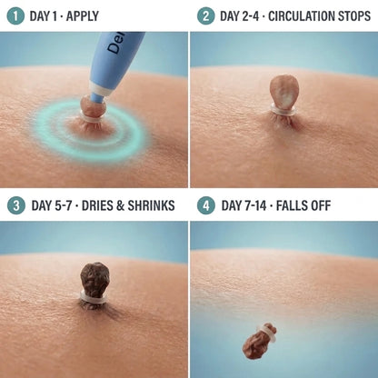 SUVORA™- Painless Skin Tag Removal Kit