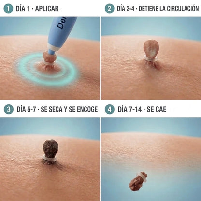 SUVORA™-Kit Indoloro para Verrugas