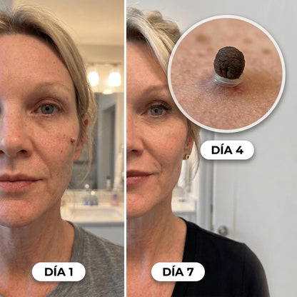 SUVORA™-Kit Indoloro para Verrugas
